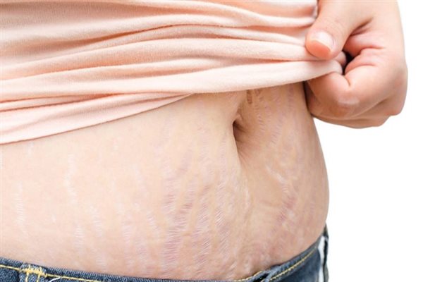 درمان ترک پوستی با موثر ترین روش های خانگی