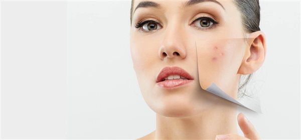 درمان جوش: روش‌های ساده و تست‌شدۀ از بین بردن فوری جوش صورت